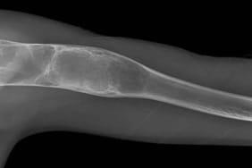 KTÜ'lü-uzmandan-hastalara-kemik-tümörü-uyarısı--Uzuv-kaybı-önlenebilir!